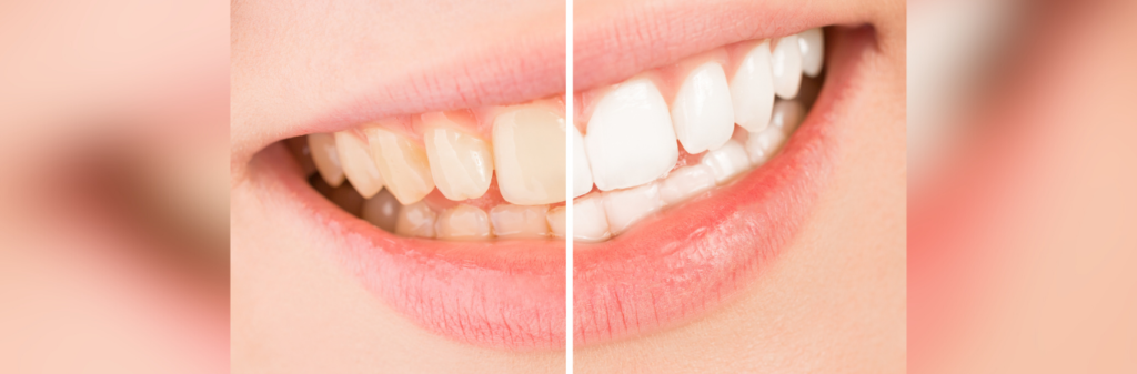 Teeth whitening success dental clinic Jakarta