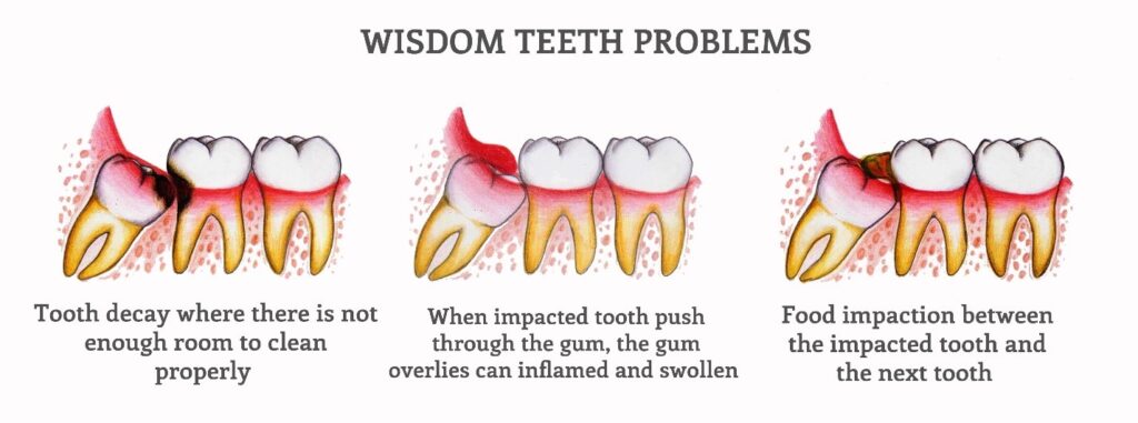 Reason why you need to remove your wisdom tooth