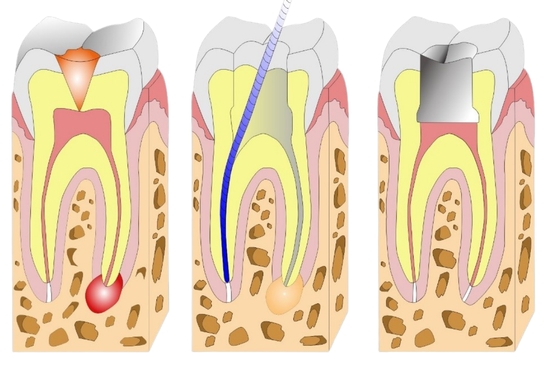 root canal treatment jakarta