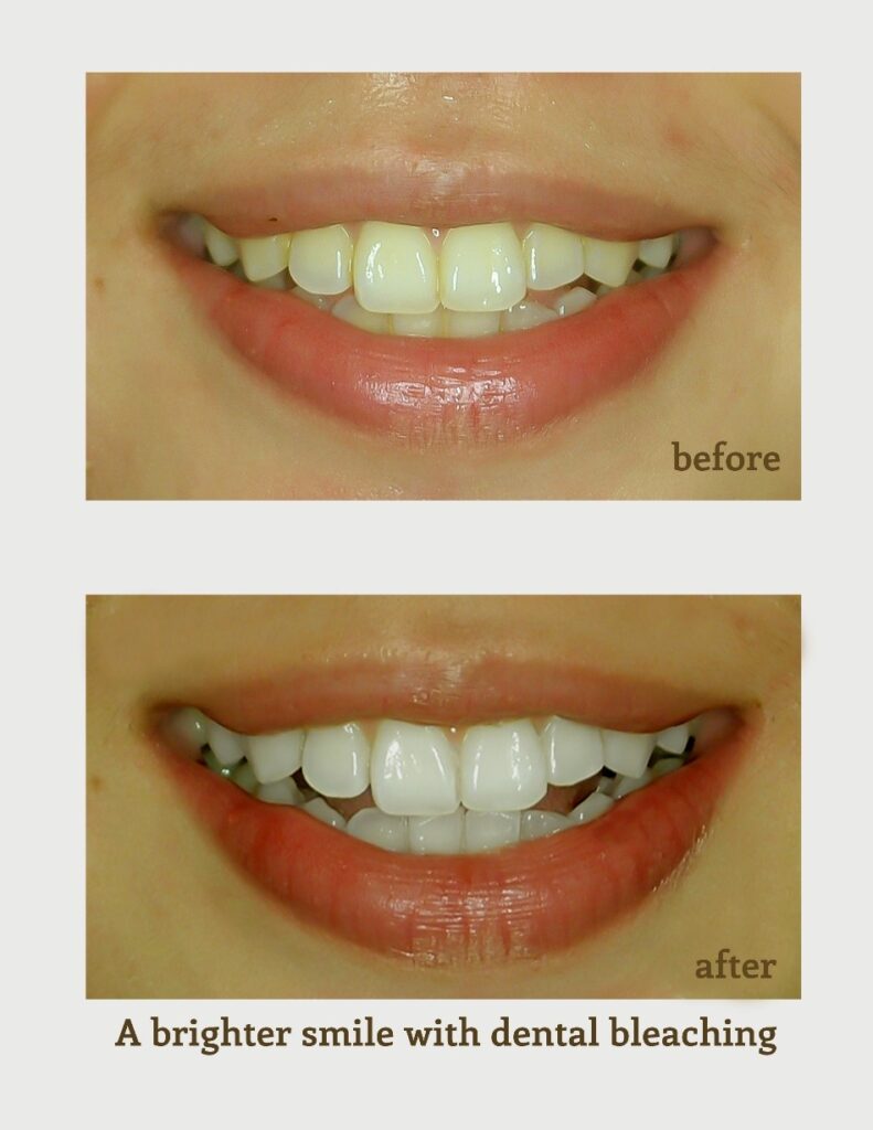 Teeth whitening jakarta